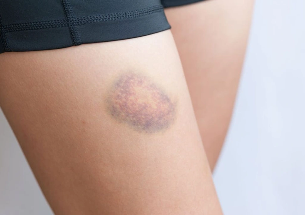 Bầm tím bắp chân và cách xử lý nhanh nhất