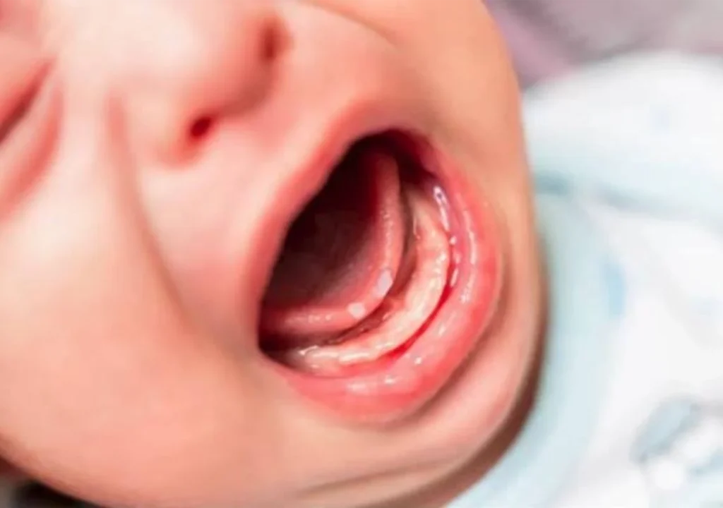 Hình ảnh bé gái đang bị nhiệt lưỡi