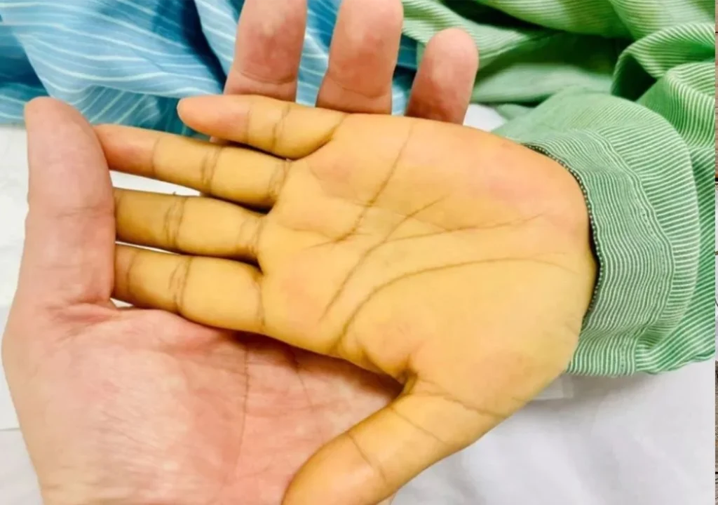 Hình ảnh bị vàng da
