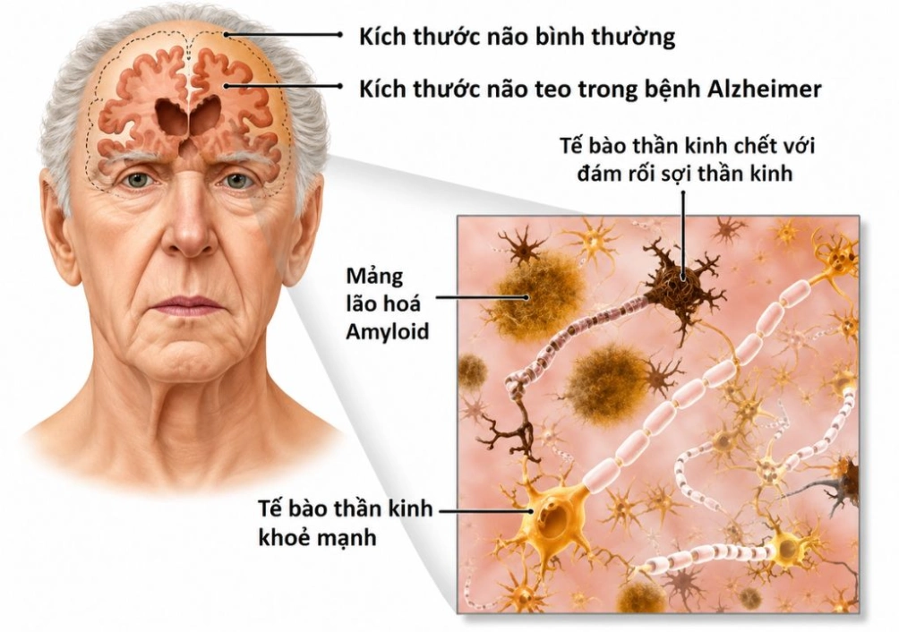 Hình ảnh mô phỏng Nguyên nhân gây bệnh Alzheimer