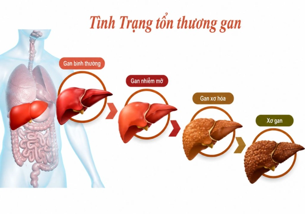 Hình ảnh tình trạng gan bị tổn thương
