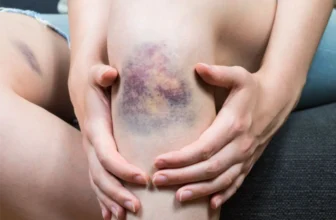Hình ảnh vết bầm tím ở đầu gối