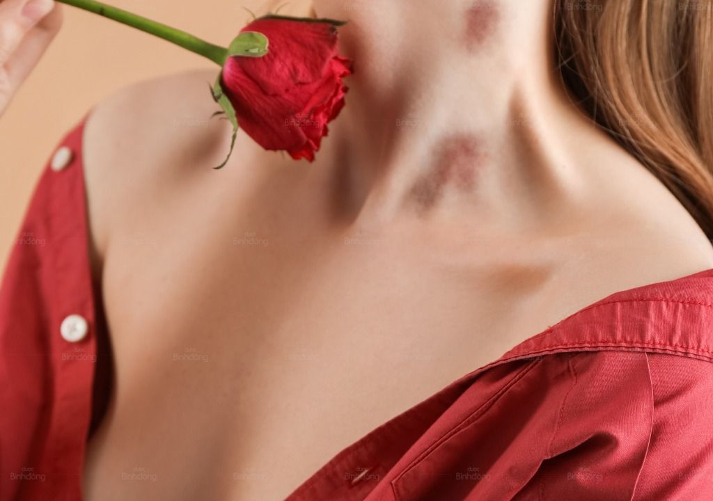 Hình chụp về dấu Hickey