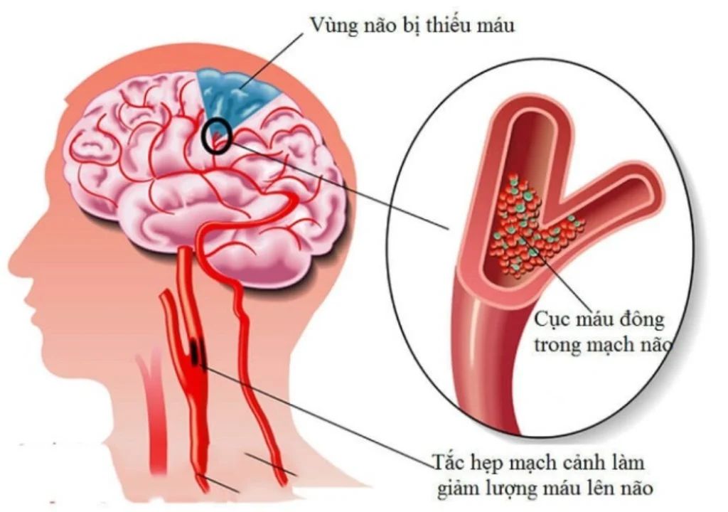 mô hình mạch thiếu máu não