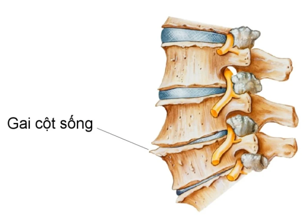 Mô hình xương bị gai cột sống