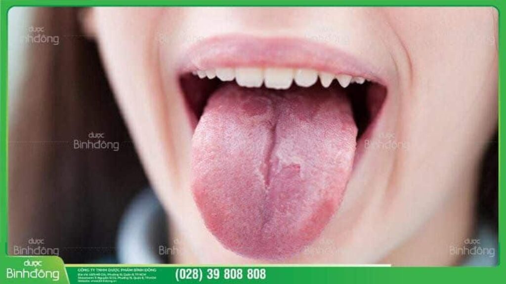 Nhiệt lưỡi có nguy hiểm không?