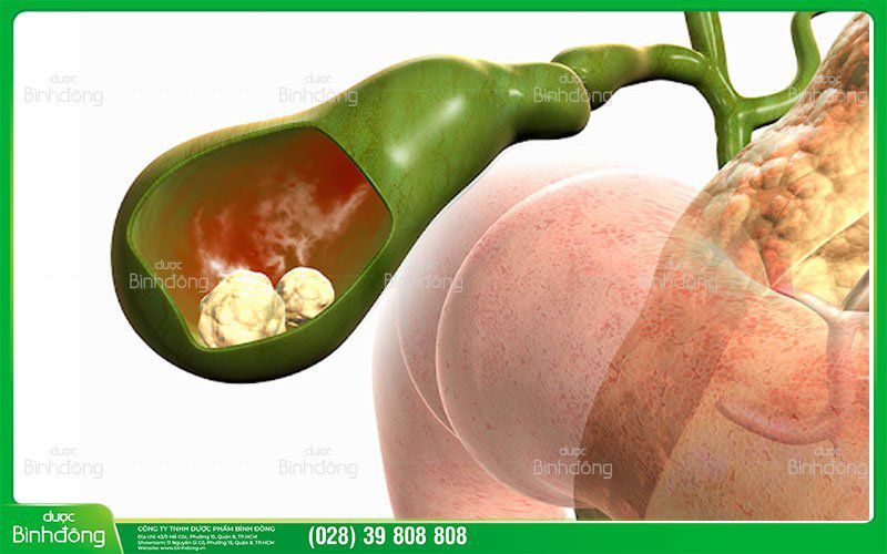 Polyp túi mật là khối u phát triển vào bên trong túi mật.