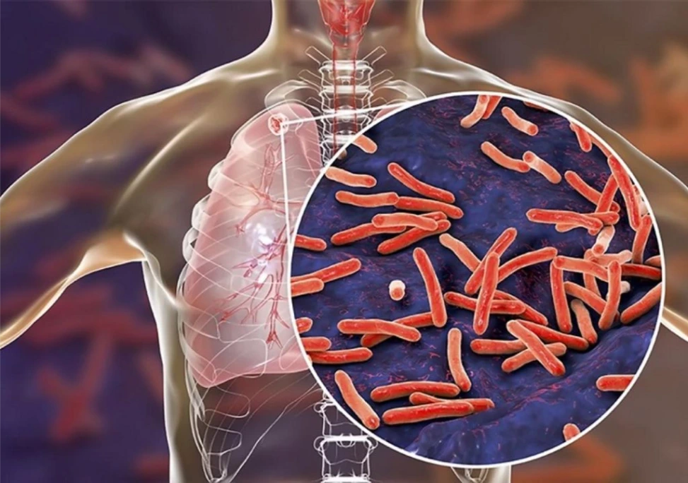 vi khuẩn lao Mycobacterium Tuberculosis