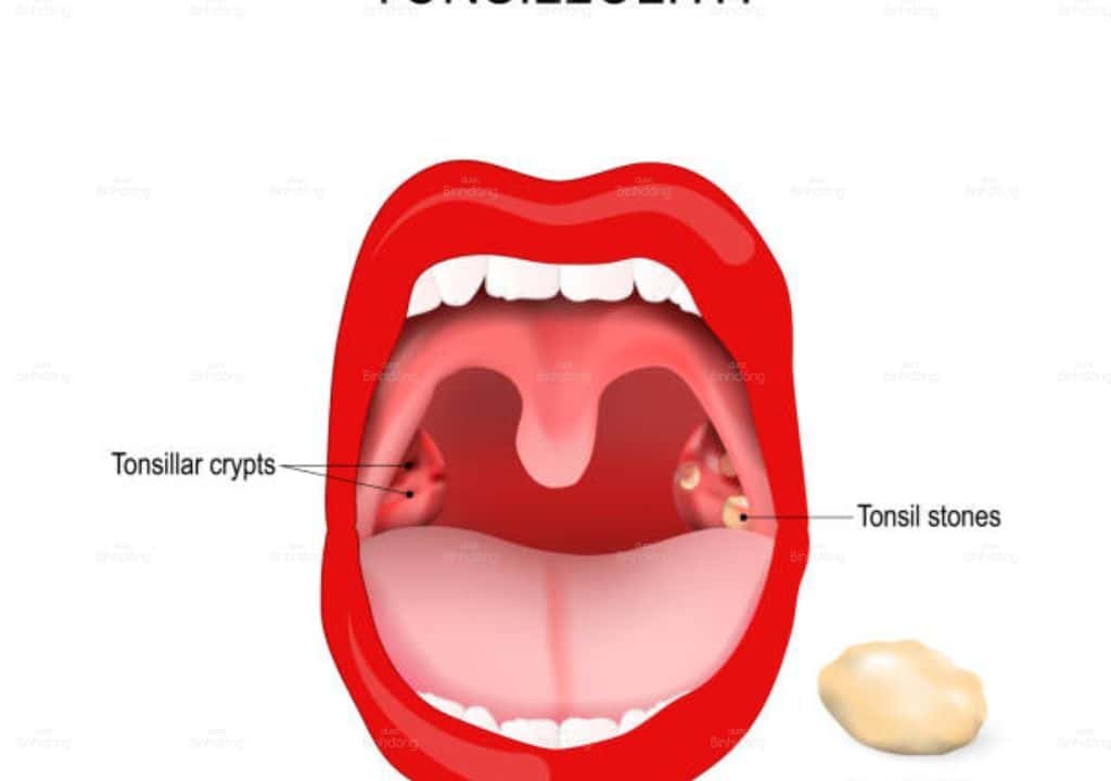 Tổng quan về viêm amidan hốc mủ