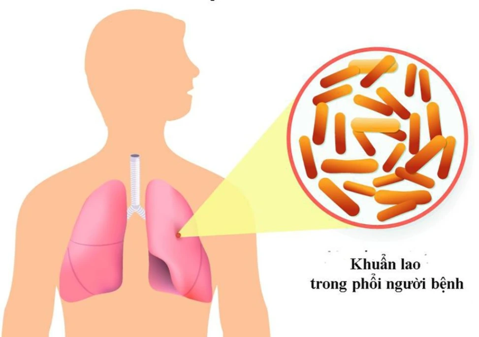 Hình ảnh bệnh lao phổi