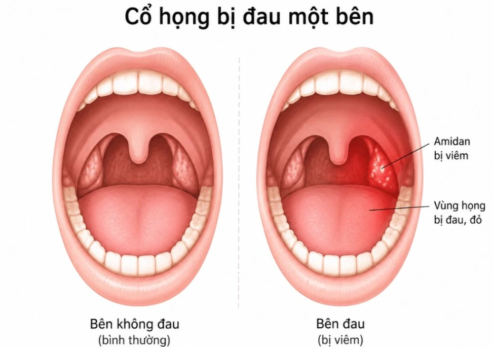 Hình ảnh cổ họng bị đau một bên 
