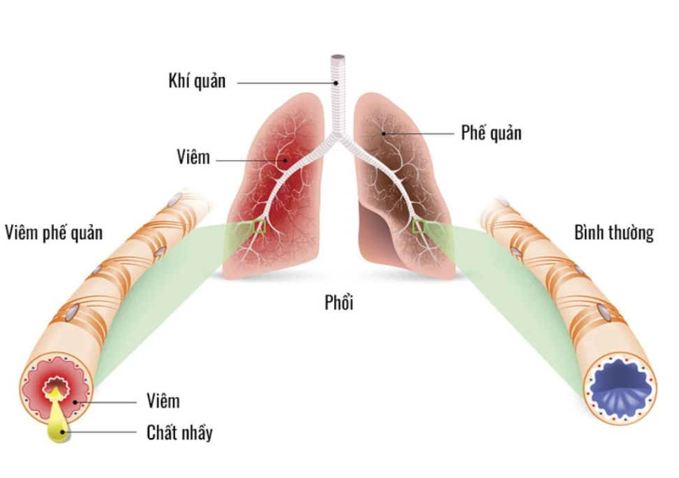 Hình ảnh mô tả phế quản bị viêm