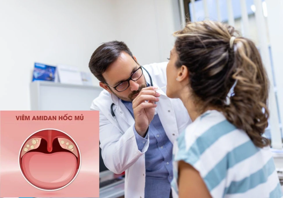 Hình ảnh Viêm amidan hốc mủ