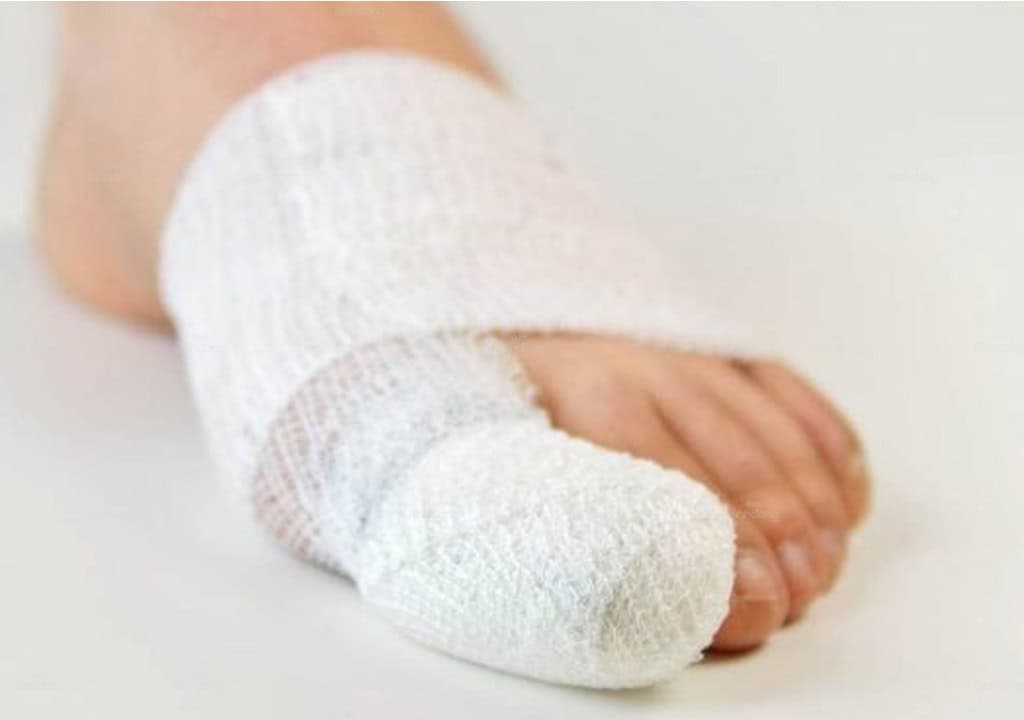 Quấn băng quanh ngón chân bị vấp.