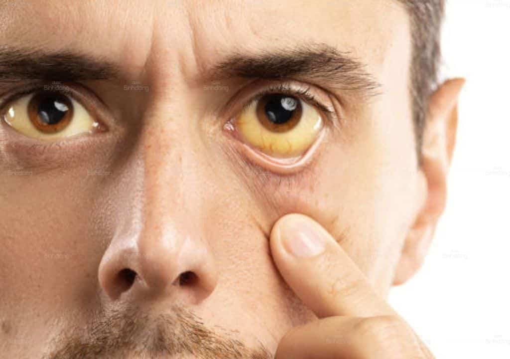 Hình ảnh người đàn ông bị mắt vàng do bệnh gan