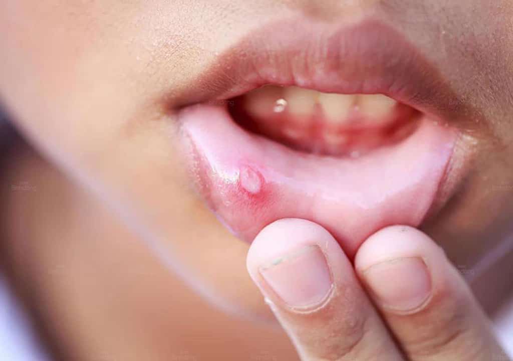 Hình chụp về Nhiệt miệng