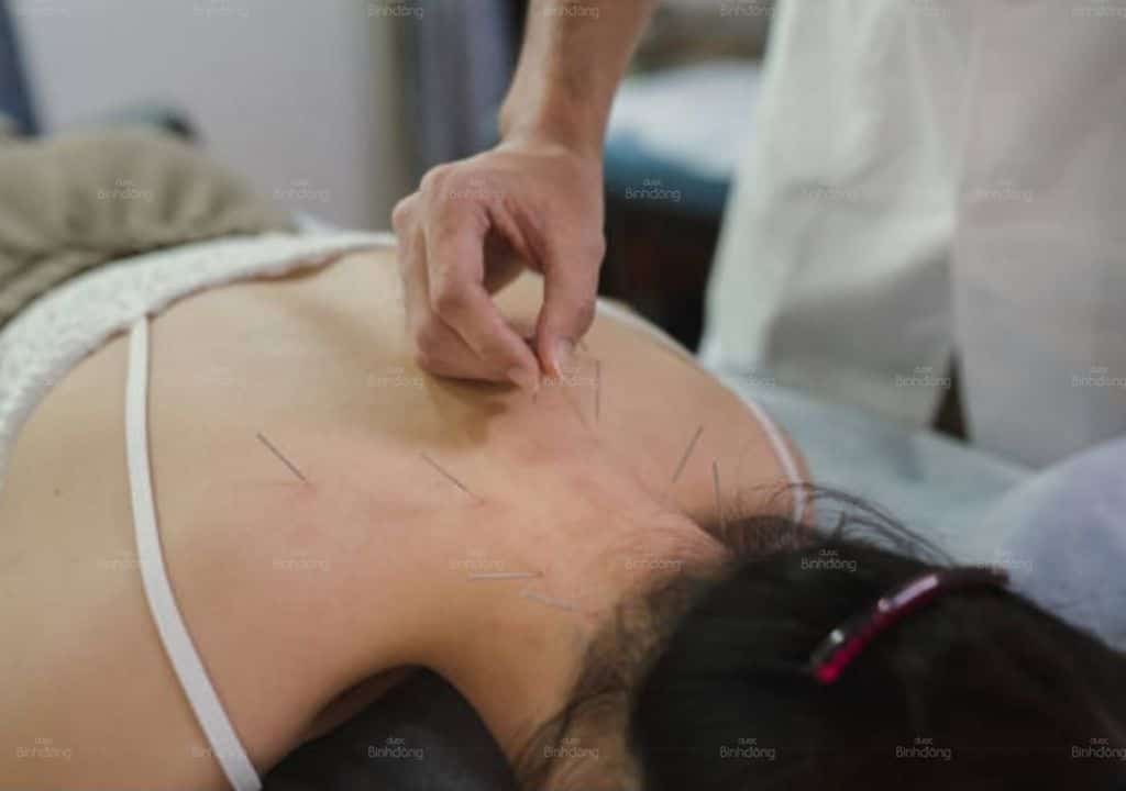 Hình ảnh người phụ nữ đang châm cứu để trị bệnh đau lưng trên