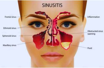 Hình ảnh mô tả về các vị trí dễ mắc viêm xoang nhất