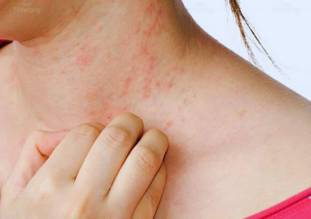 Hình ảnh người phụ nữ đang bị mụn nhọt