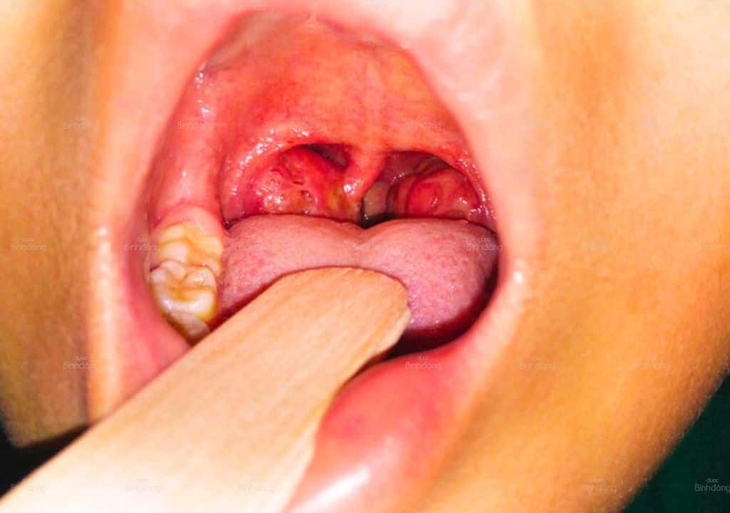 Hình ảnh về cổ họng bị khô