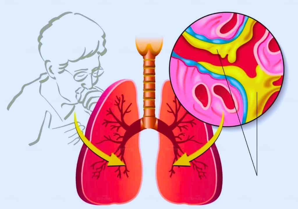Hình ảnh về phổi và quy trình tạo ra chất đờm