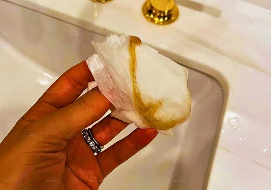 Hình ảnh đờm nâu