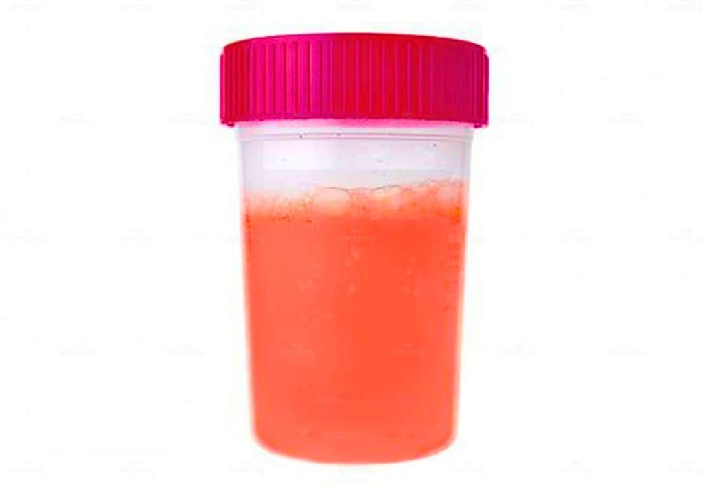 Hình ảnh về nước tiểu màu hồng