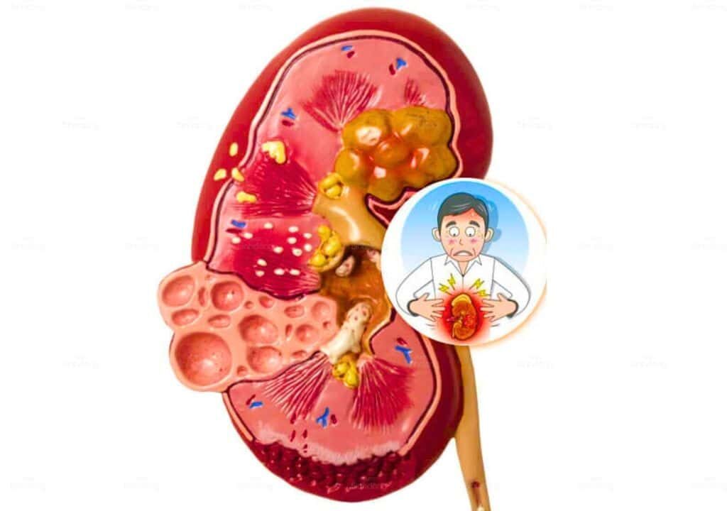 Hình ảnh về quản thận âm bị hư