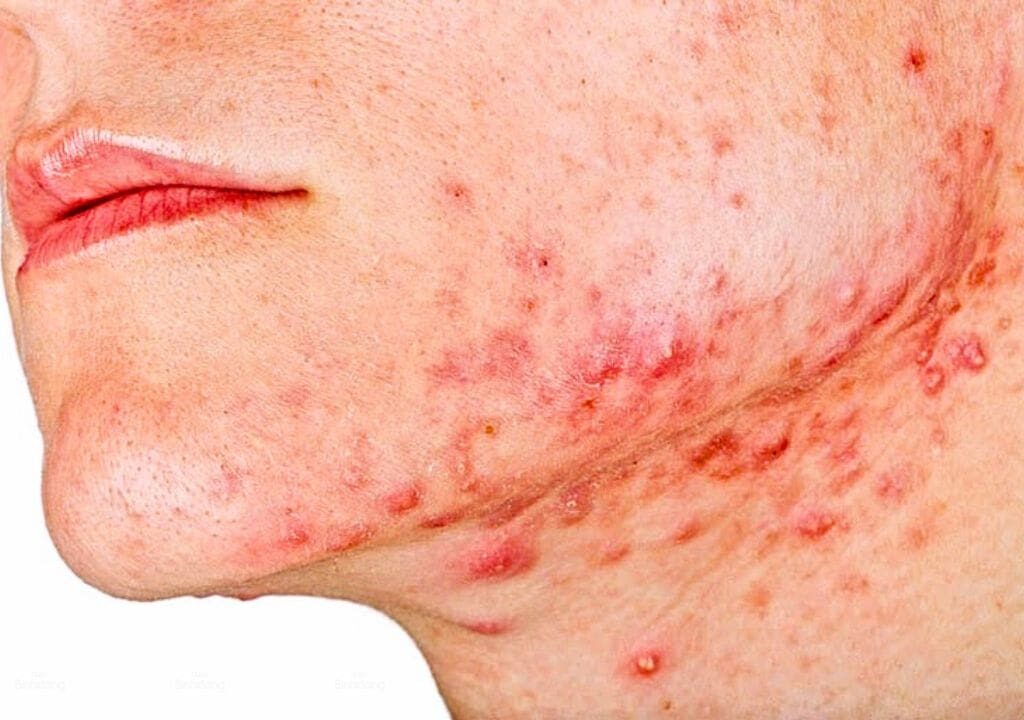 Hình ảnh người phụ nữ đang bị nổi mụn