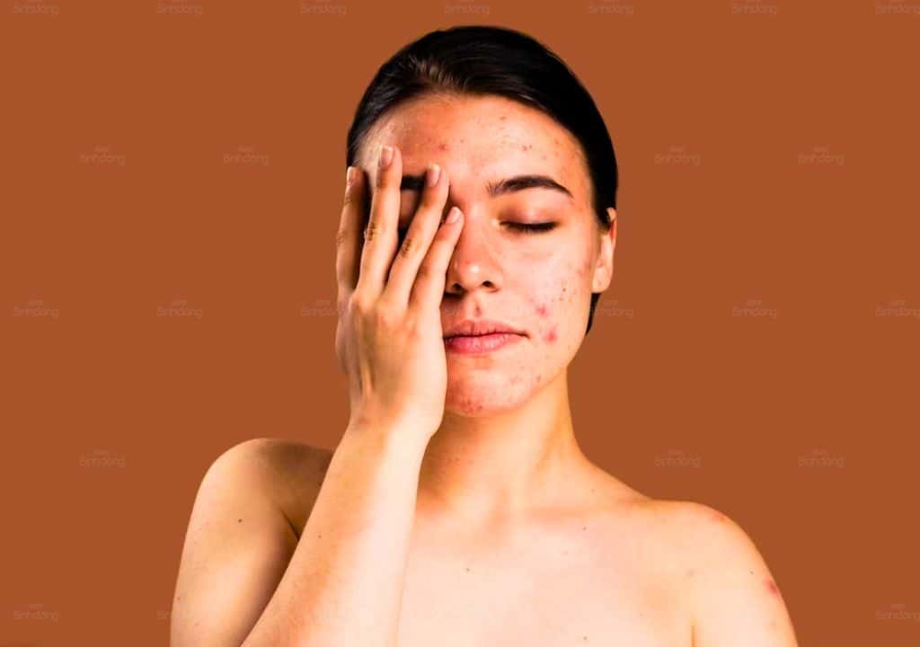Hình ảnh người phụ nữ đang bị nóng trong người và nổi mụn