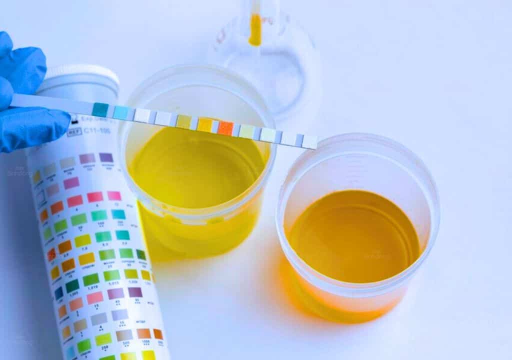 Hình ảnh về các loại màu sắc của nước tiểu