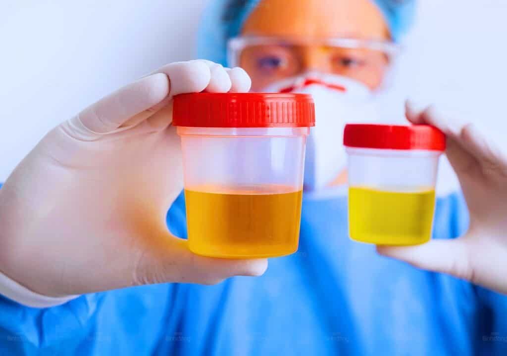 Hình ảnh người bác sĩ đang xem màu nước tiểu