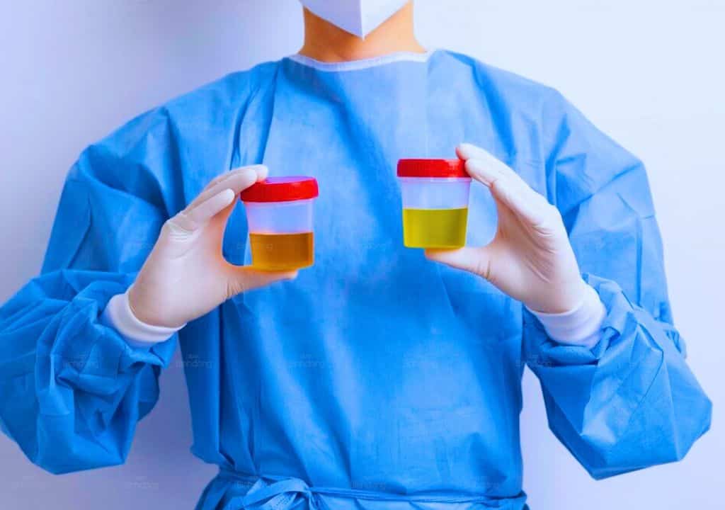 Hình ảnh về nước tiểu vàng sậm