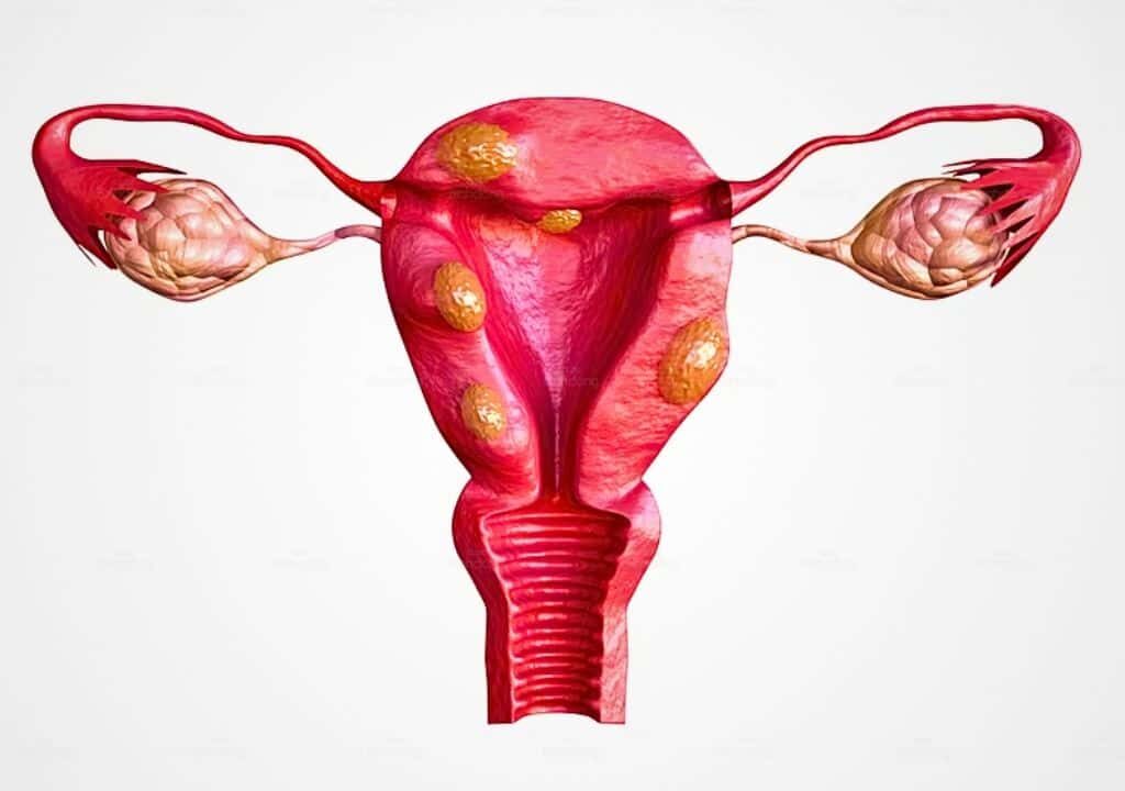 Hình ảnh về bộ phận tử cung của phụ nữ bị u xơ tử cung