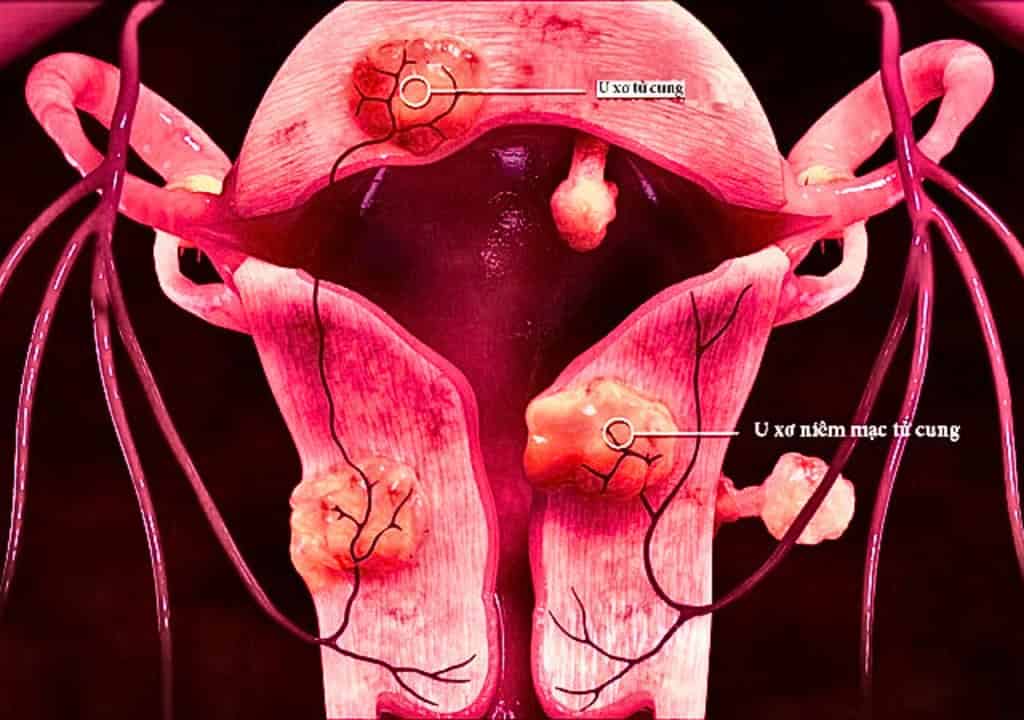 Hình ảnh bộ phận tử cung bị u xơ