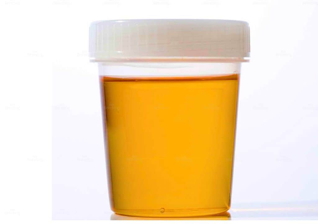 Hình ảnh về màu của nước tiểu có màu cam