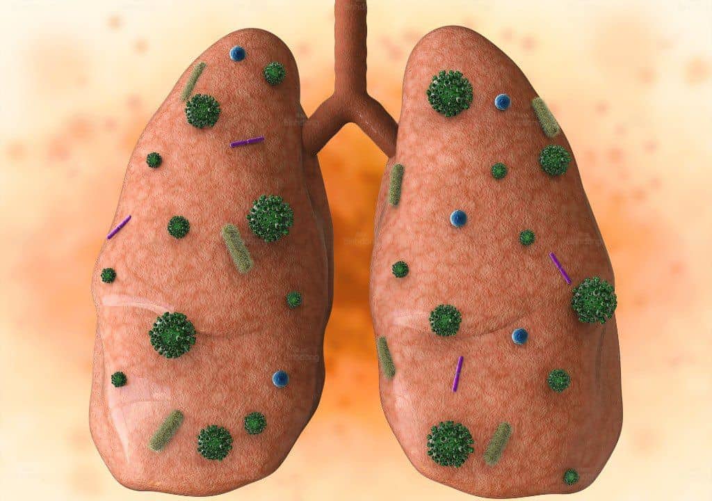 Hình ảnh về phổi đang gặp vấn đề về bệnh bụi phổi nghề nghiệp