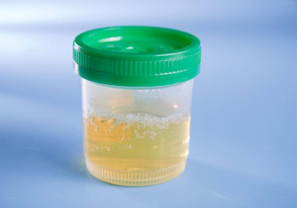 Hình ảnh về nước tiểu có nhiều bọt khí