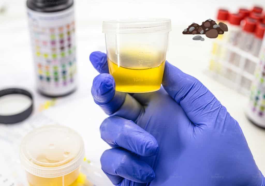 Hình ảnh về nước tiểu màu vàng đang có cặn