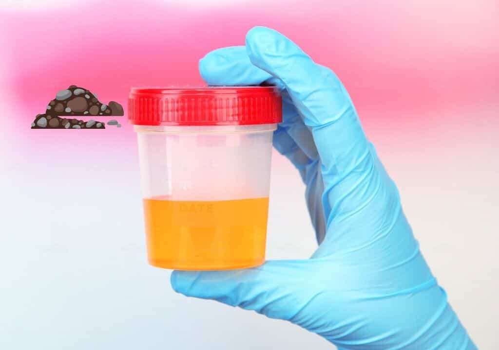 Hình ảnh về nước tiểu màu cam đang có cặn