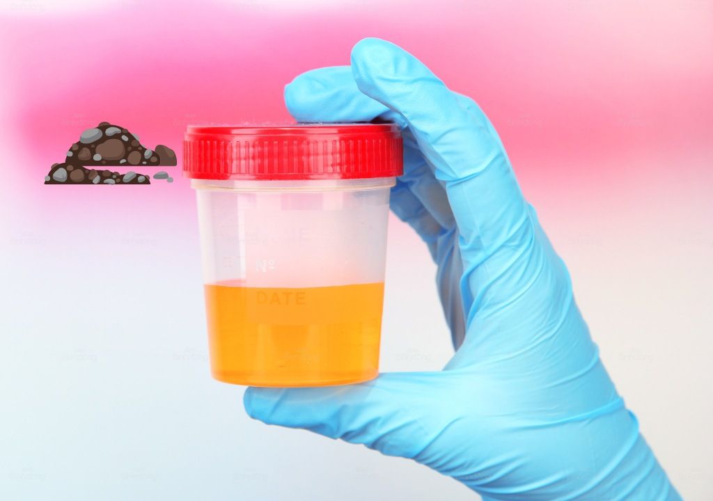 Hình chụp về nước tiểu có cặn