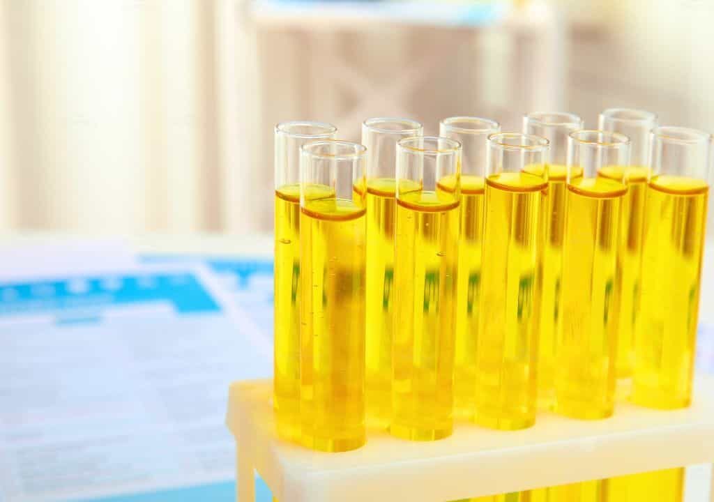 Hình ảnh về nước tiểu màu vàng tươi và có mùi hôi tanh