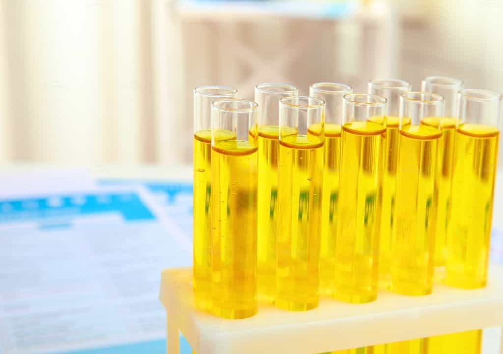 Hình ảnh về nước tiểu màu vàng tươi và có mùi hôi tanh