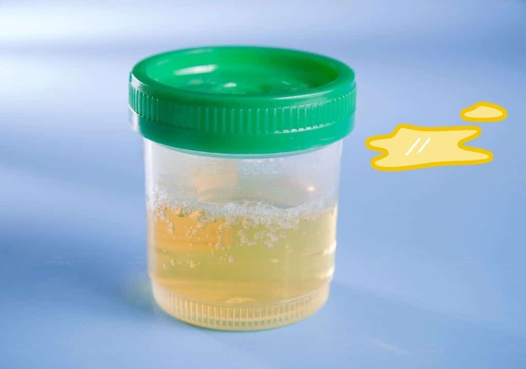 Hình ảnh về nước tiểu có bọt kèm váng dầu