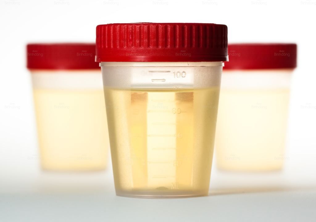 Hình chụp về nước tiểu màu đục