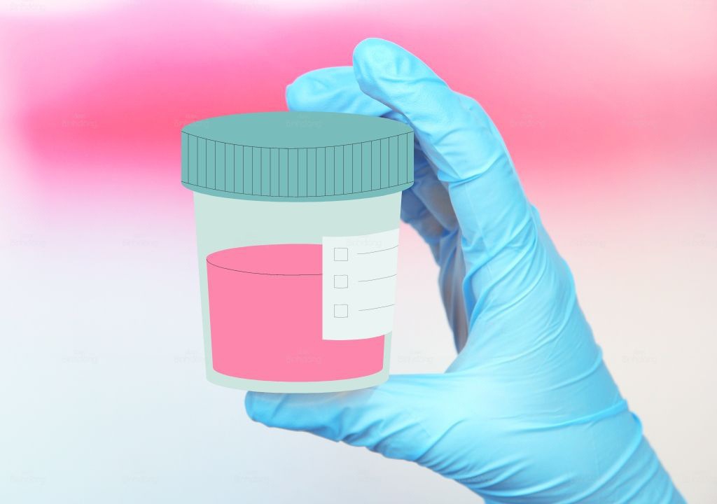 Hình chụp về nước tiểu màu hồng