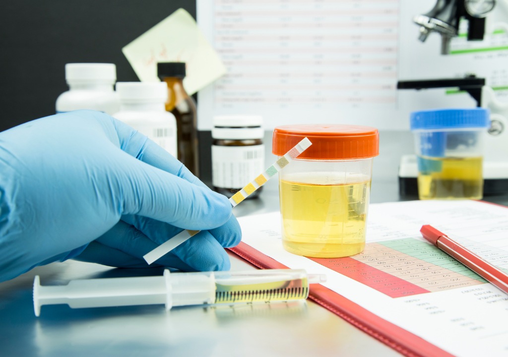 Hình chụp về nước tiểu đang được xét nghiệm