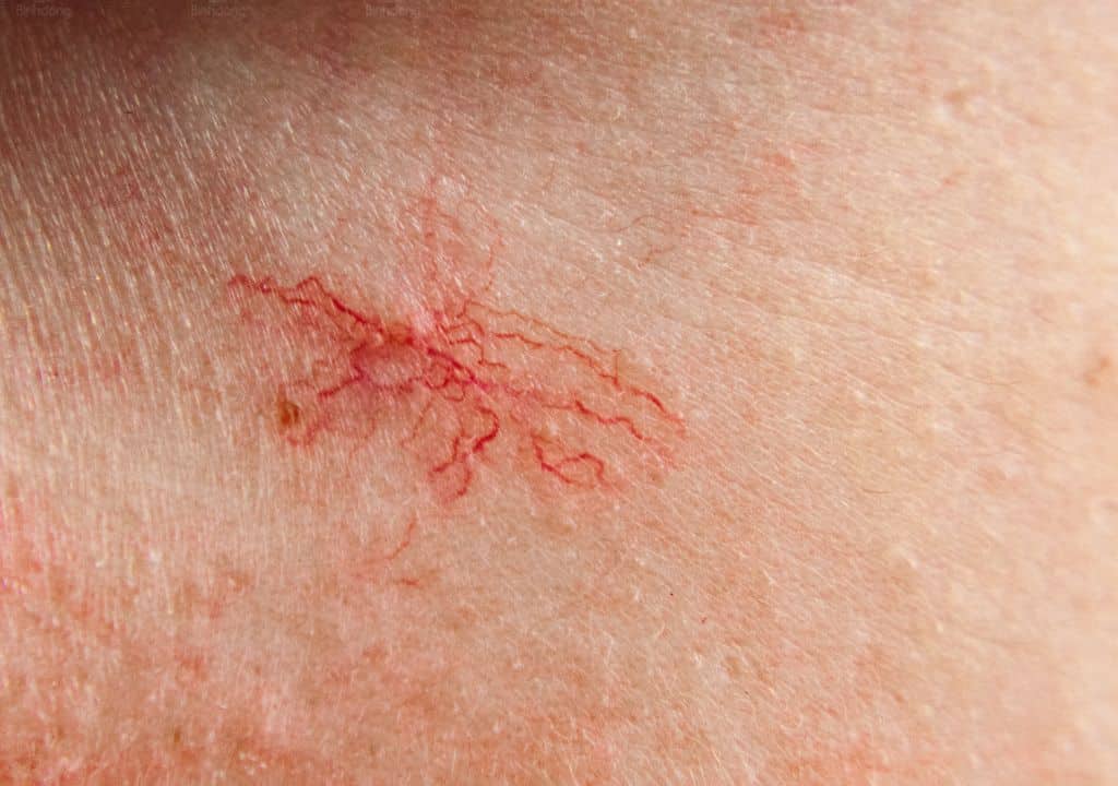 Hình ảnh về dấu sao mạch trên da