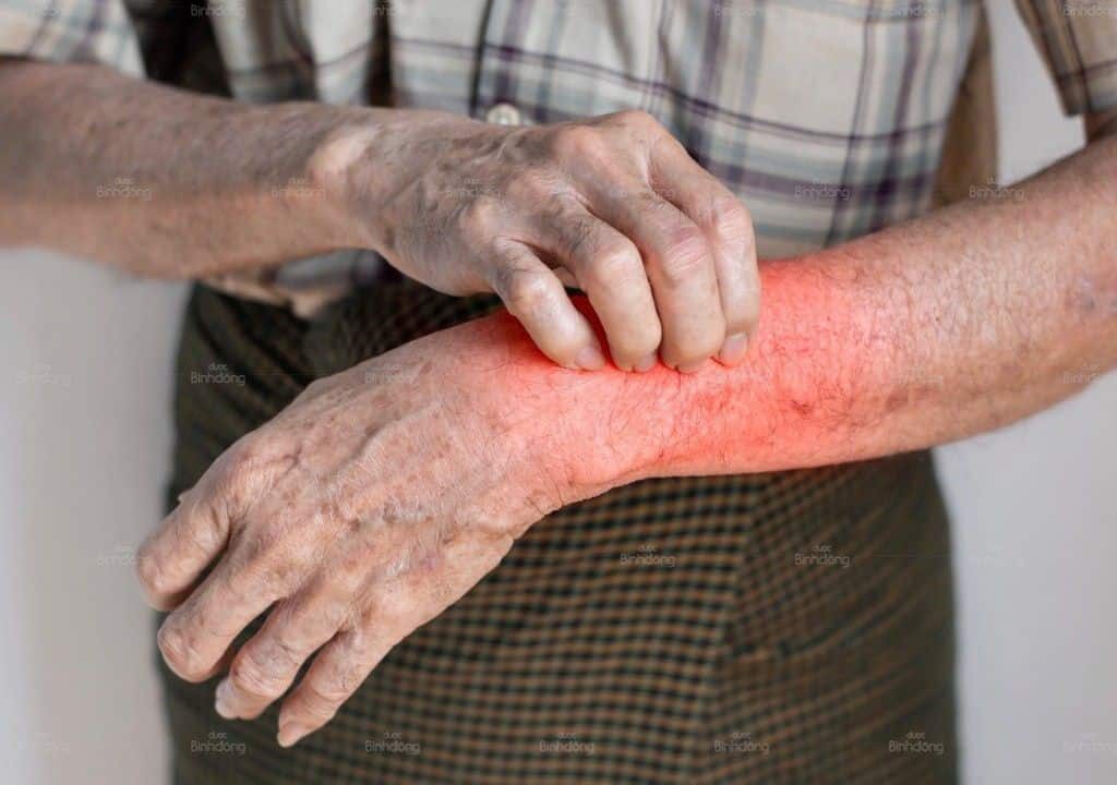 Hình ảnh về người đàn ông đang bị mẩn ngứa về đêm
