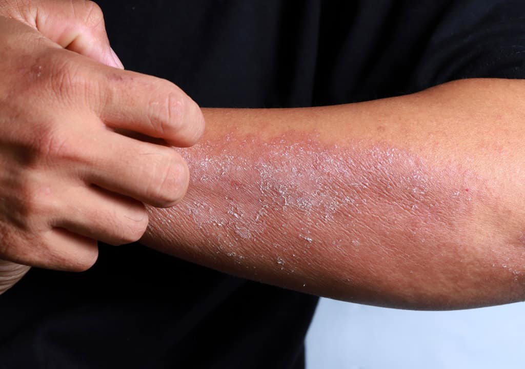 Hình ảnh người đàn ông đang bị rôm sảy